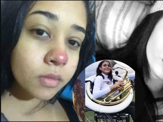 Dos jóvenes quedan parapléjicas tras infecciones por piercings nasales: casos reavivan las alarmas sanitarias en Latinoamérica