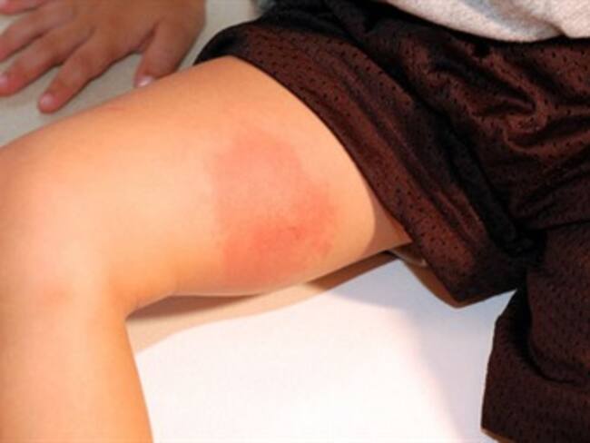 ¿Te choca que te piquen los moscos en las vacaciones?