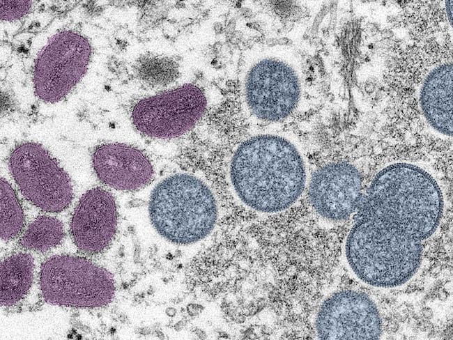 Edomex confirma dos casos de viruela del mono