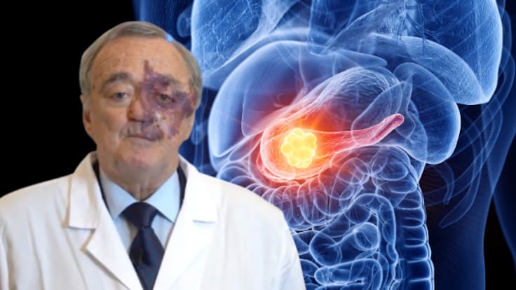 Mariano Barbacid vs cáncer de páncreas: La terapia del CNIO que elimina tumores sin efectos secundarios