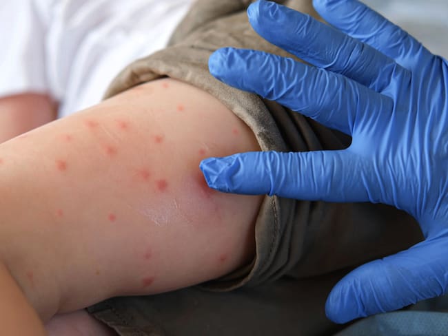 ¡Alerta sanitaria! El sarampión no cede en México y ya suma casi 13 mil contagios