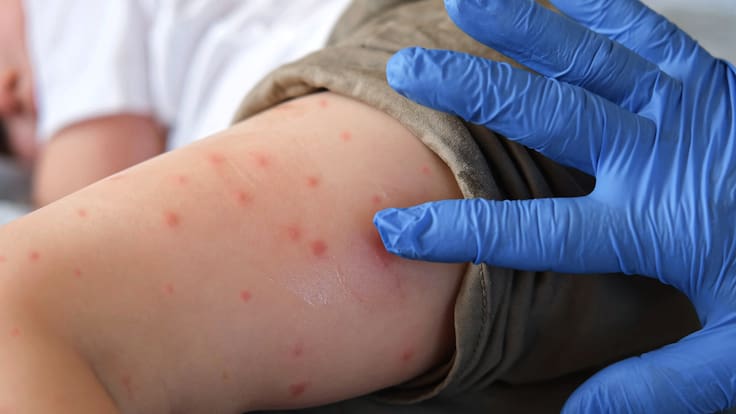 ¡Alerta sanitaria! El sarampión no cede en México y ya suma casi 13 mil contagios