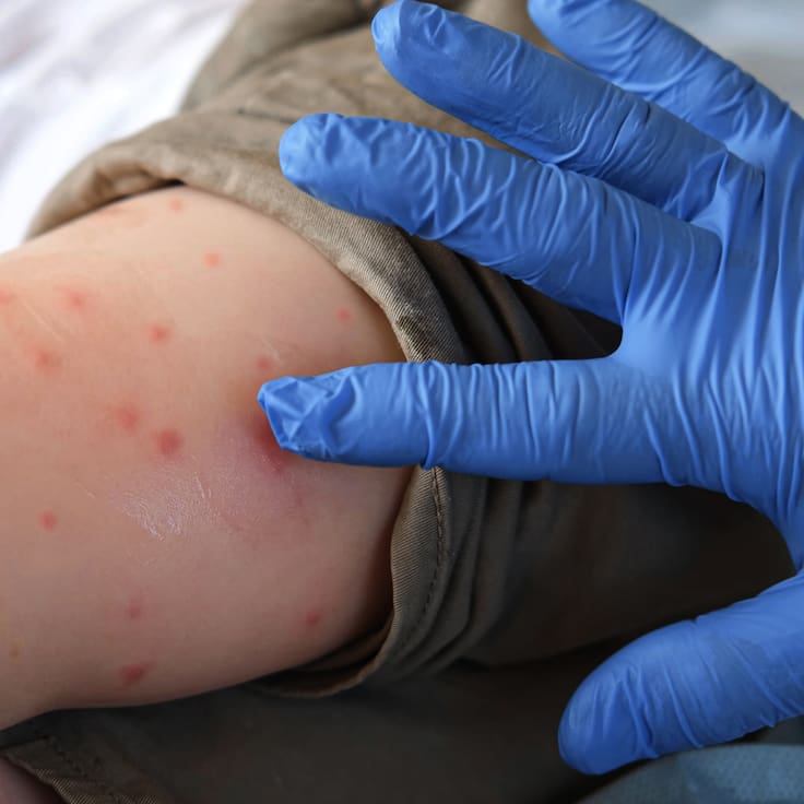 ¡Alerta sanitaria! El sarampión no cede en México y ya suma casi 13 mil contagios