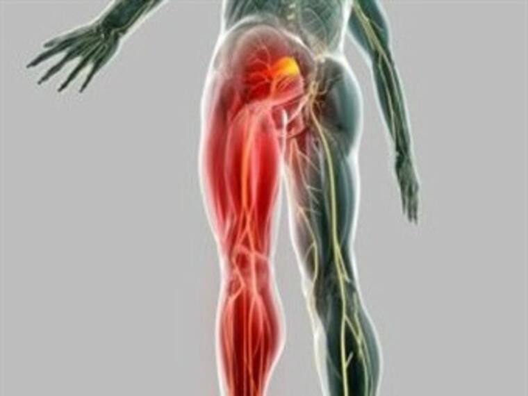 "¡Me duele la ciática!"