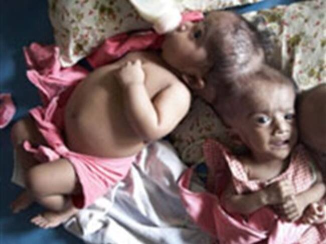 Doctores australianos tratan de separar a siamesas unidas por la cabeza